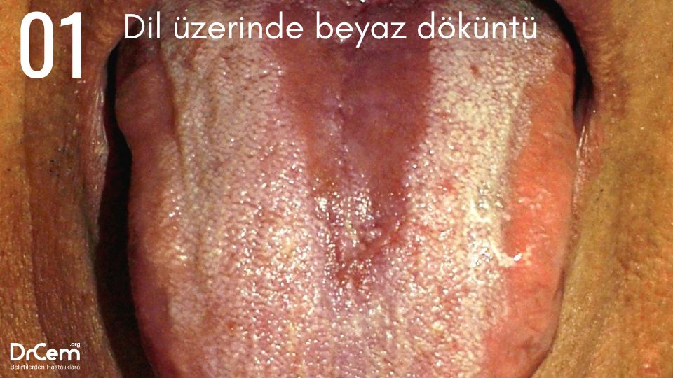 Oral Kandidiyazis görseli - DrCem hastalık rehberi